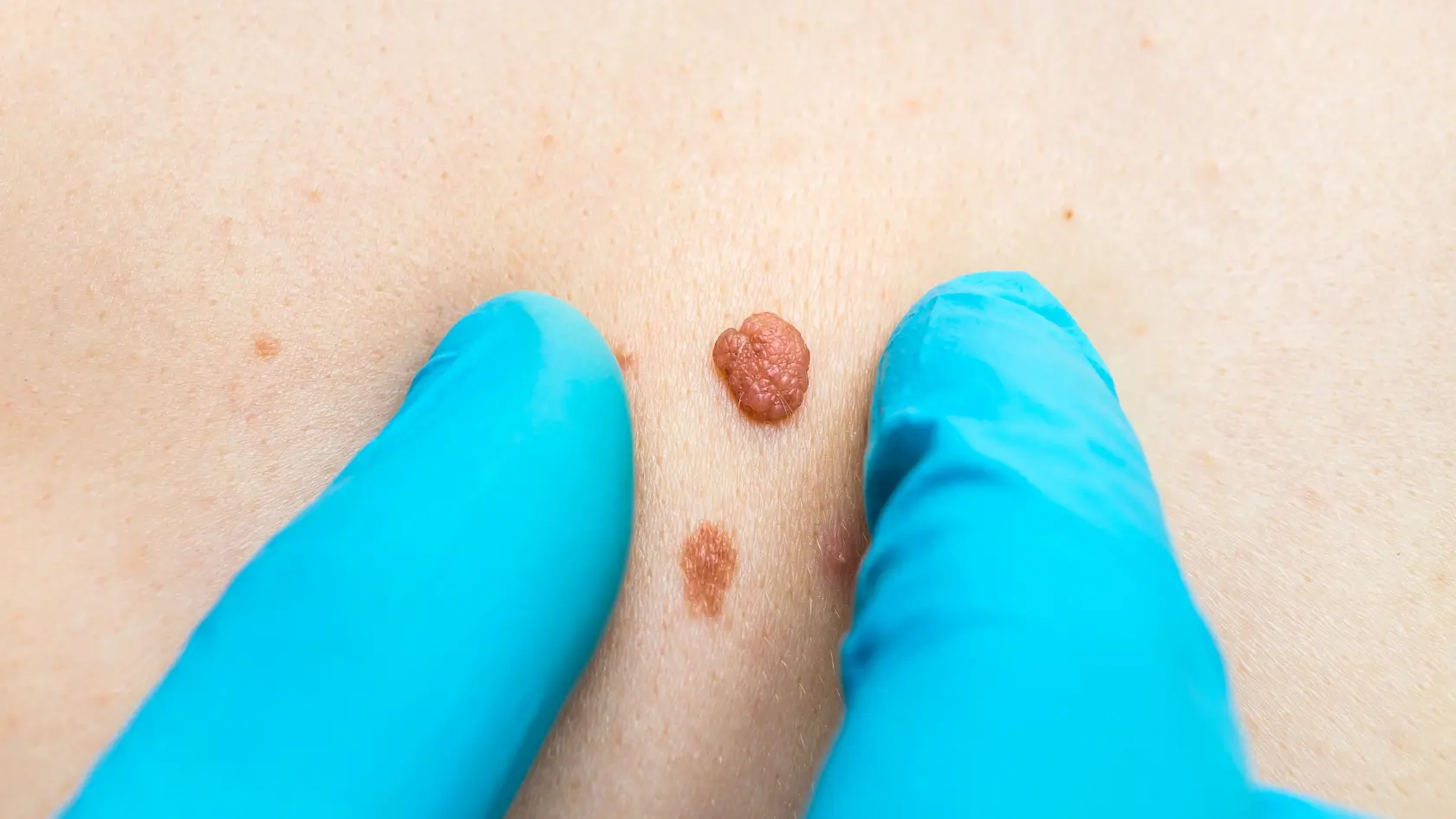 Cryotherapy for warts in Gorleston clinic
