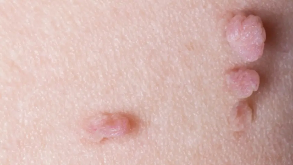 Cryotherapy skin tag removal in Gorleston